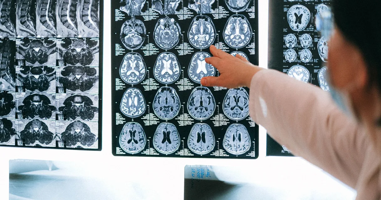 Médica apontando para imagens de ressonância do cérebro em um painel, ação do Venvanse e da cocaína na dopamina